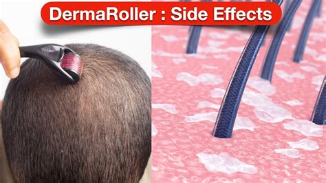 derma roller ph|Derma Roller Side Effects .